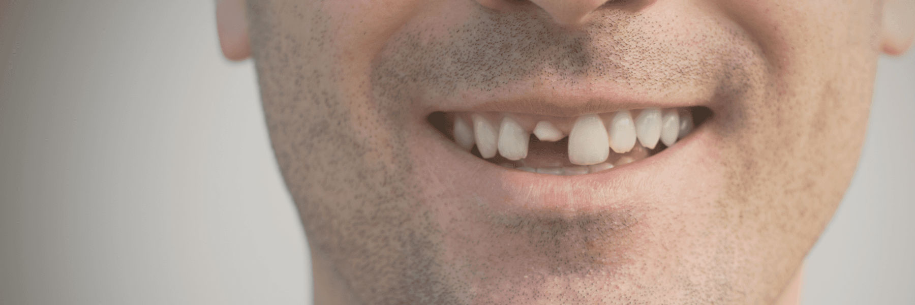 Damaged Teeth