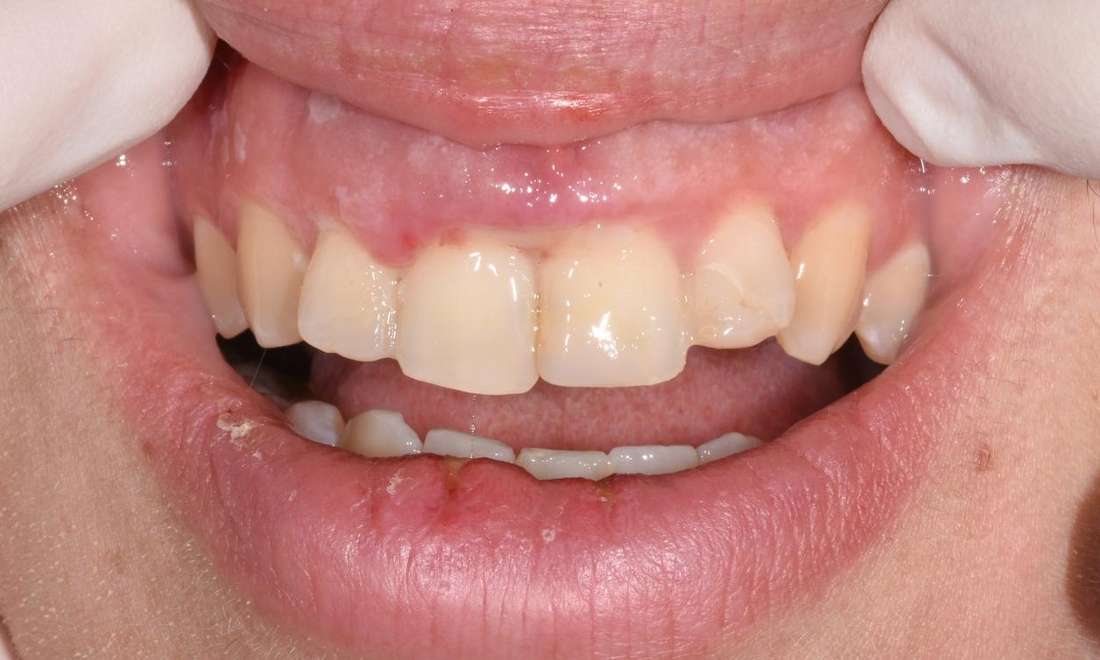 Sydney emergency dentist dislodged tooth