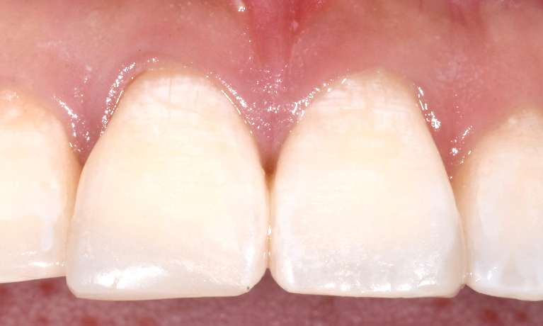 Chipped-Tooth-After-Image