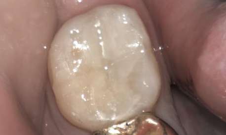 Cracked-Filling-After-Image
