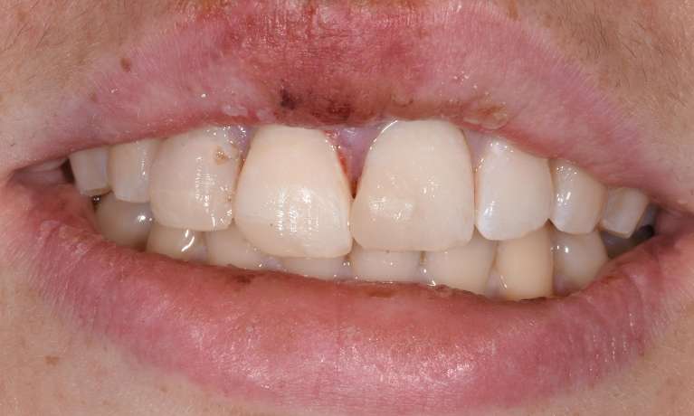 Dental-Trauma-and-Broken-Tooth-After-Image