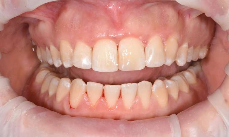 Dislodged-Tooth-After-Image