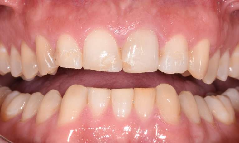 Trauma-Broken-Tooth-After-Image
