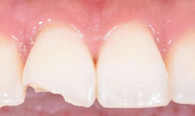 Chipped-Tooth-Before-Image