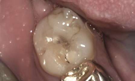 Cracked-Filling-Before-Image