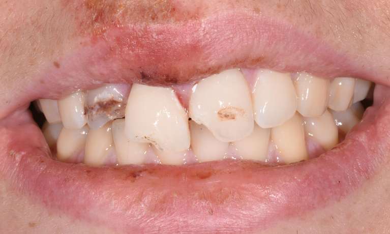 Dental-Trauma-and-Broken-Tooth-Before-Image