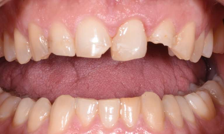 Trauma-Broken-Tooth-Before-Image